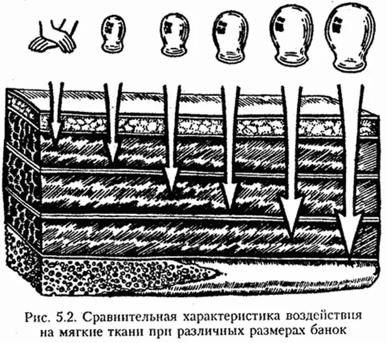 Как ставить банки в домашних условиях