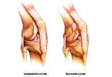 Хруст в коленях при сгибании, что делать если хрустят колени?