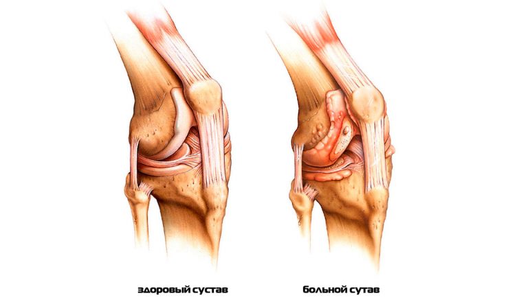 Почему хрустят колени и как это вылечить?