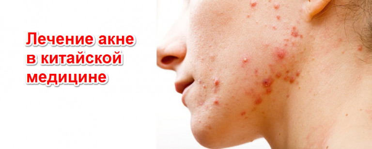 Методы избавления от угревой сыпи с помощью банок