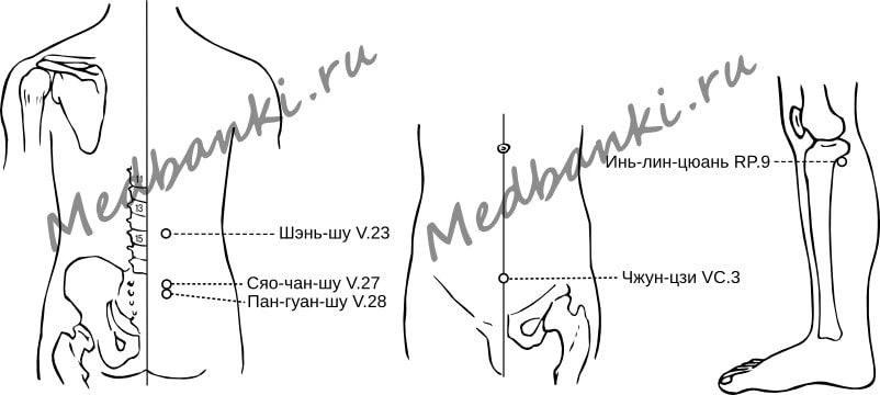 38. Инфекции мочевыделительной системы, лечение банками Haci