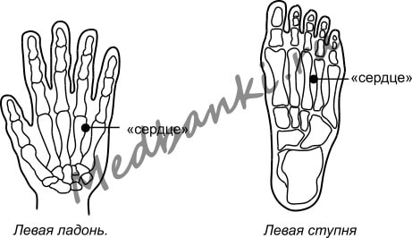 2. Ишемическая болезнь сердца, лечение присосками Haci